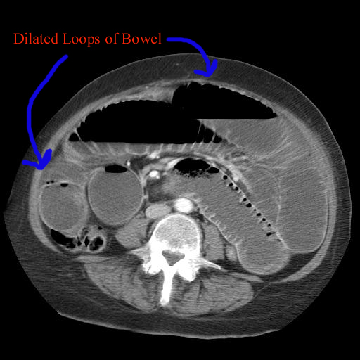 icd 10 code for dilated large bowel